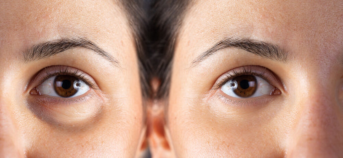 How To Get Rid of Dark Circles Under the Eyes?