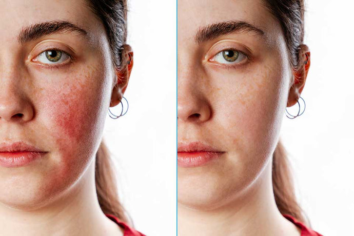 Vitamin C Serum Can Help Your Hyperpigmentation