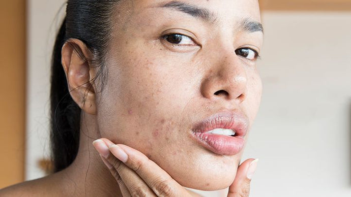 Explain the Different Causes of Skin Breakouts