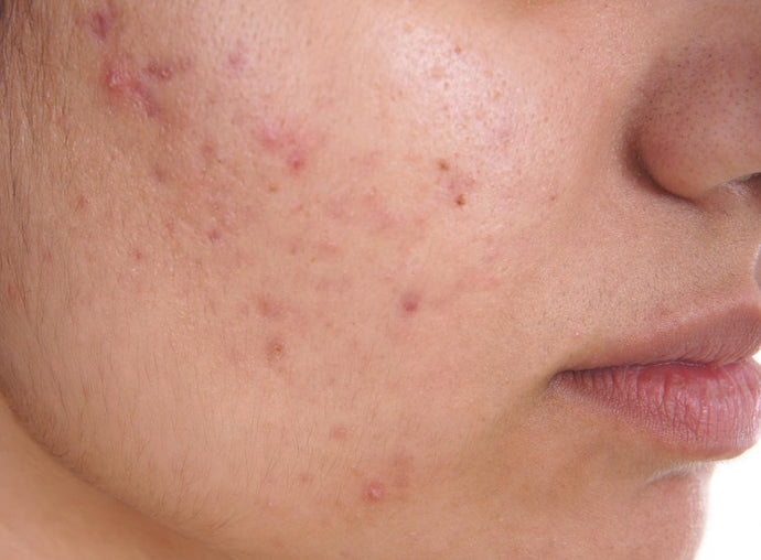 Best Serum for Dull Acne Prone Skin
