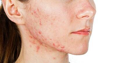 Night serum for acne prone skin
