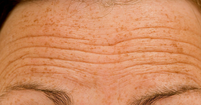 Best ways to get rid of forehead wrinkles at home