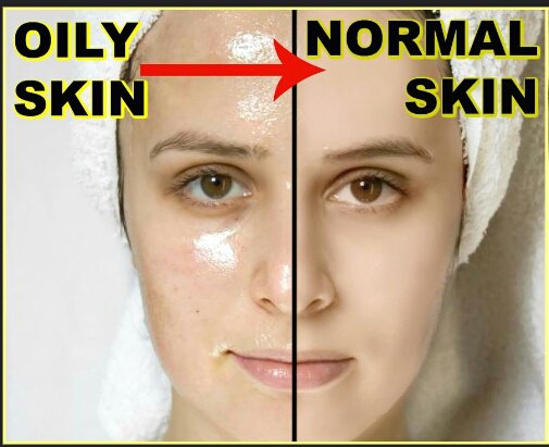 Why do I have Oily Skin? Hormones vs Lifestyle