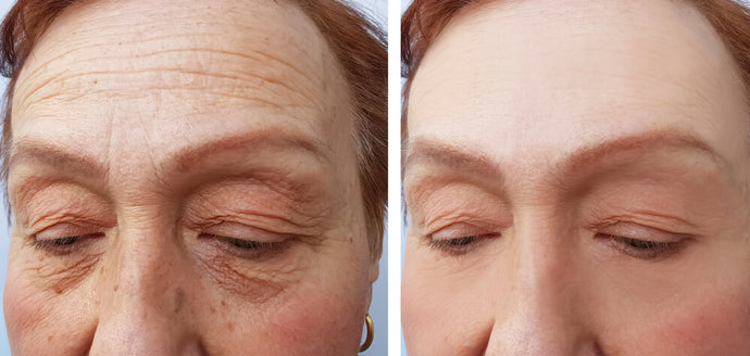 Matrixyl 3000: How to Fade Fine Lines and Wrinkles